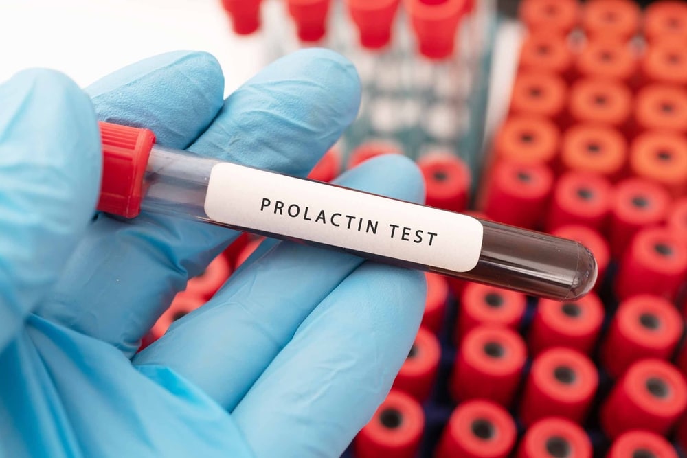 Is It Worth It To Get A Prolactin Level Test? | Health and Wellness