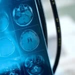 Will A Brain Scan Detect Bipolar Disorder?