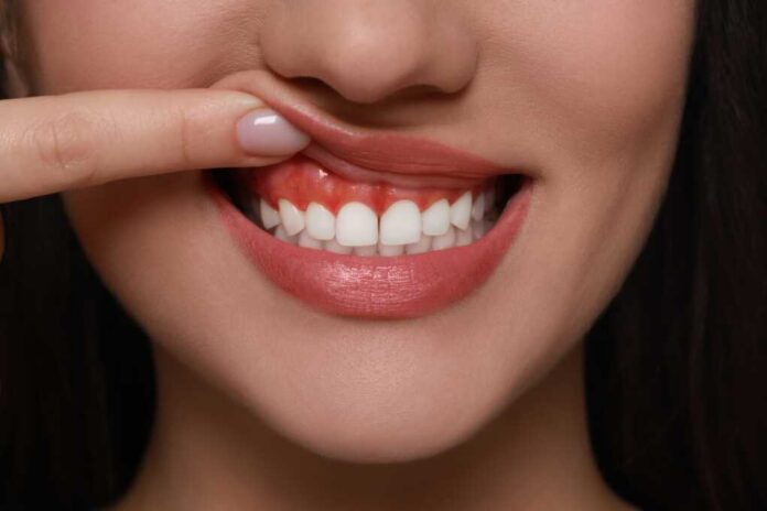 Woman,Showing,Inflamed,Gum,,Closeup.,Oral,Cavity,Health