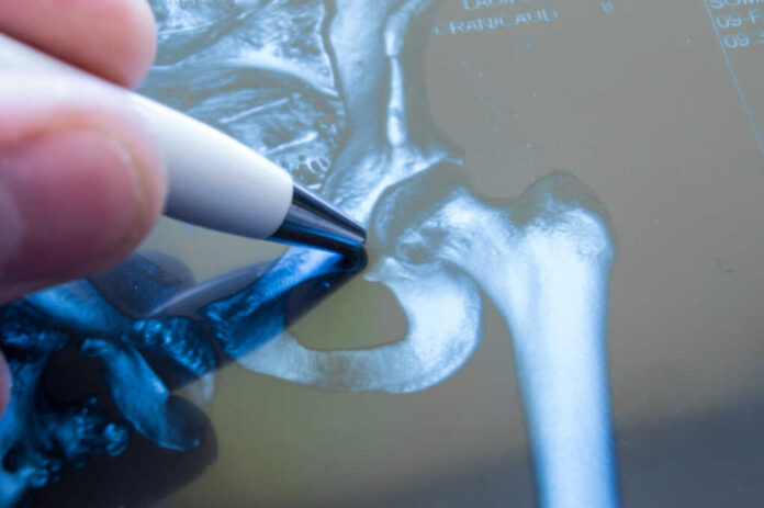 X-ray,Of,Hip,Joint.,Doctor,Pointed,On,Area,Of,Hip