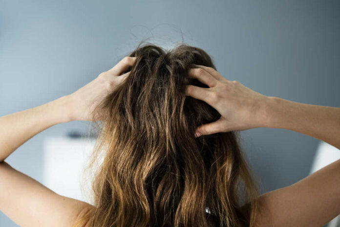 Itching,Dry,Head,Scalp,And,Long,Hair,With,Dandruff