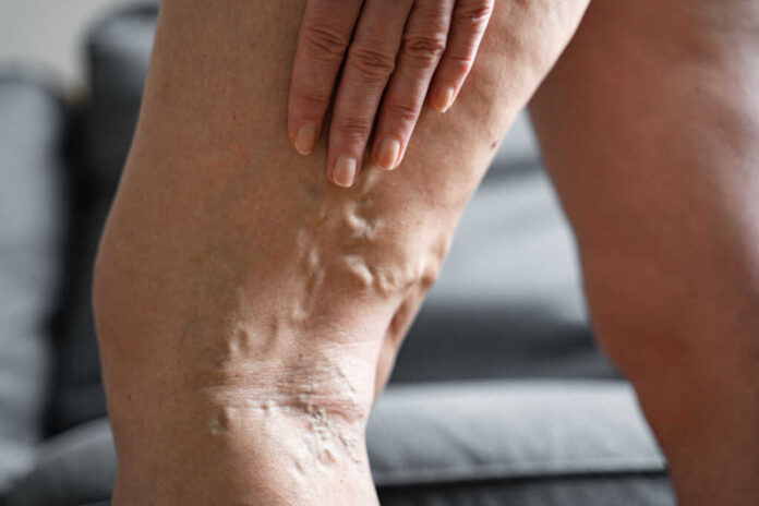 Varicose,Vein,Close,Up,Leg.,Senior,Woman,Health,Problem.,Foot
