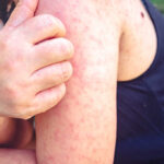 Measles Resurgence: A Public Health Crisis