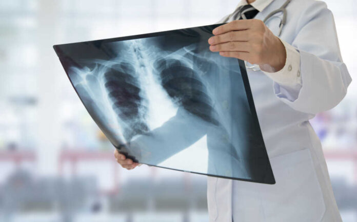 Doctor,Examining,Chest,X-ray,Film,Of,Patient,At,Hospital.
