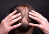 VDR: The Real Hair Loss Culprit?