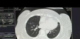 Study links severe COVID or flu to higher lung cancer risk