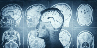 MRI scans of the brain displayed alongside a silhouette of a human head