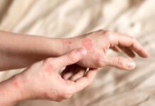 Melasma Cure: No More Harsh Chemicals? Close-up of a person's hands showing skin irritation and redness