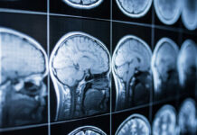 Close-up of MRI brain scans displayed on a screen