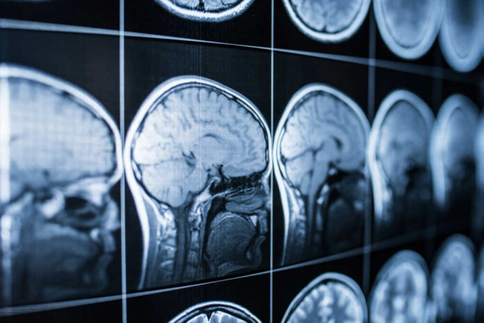 Close-up of MRI brain scans displayed on a screen
