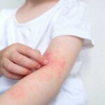 Child's arm showing skin irritation and redness