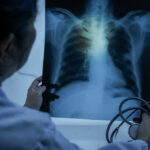 Non Smokers’ Unexpected Lung Cancer Spike Doctor examining a chest X-ray with a stethoscope in hand