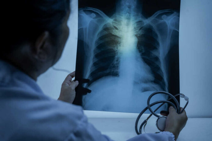 shutterstock_2482877961 Doctor examining a chest X-ray with a stethoscope in hand