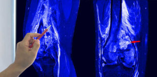 A hand pointing at an MRI scan of a knee joint on a monitor