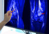 Your Bone Loss Clock Starts Earlier Than You Think A hand pointing at an MRI scan of a knee joint on a monitor
