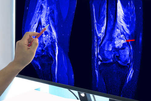 A hand pointing at an MRI scan of a knee joint on a monitor