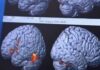 Healthy midlife habits could delay dementia by up to 13 years, study finds