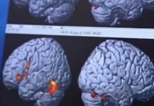Healthy midlife habits could delay dementia by up to 13 years, study finds