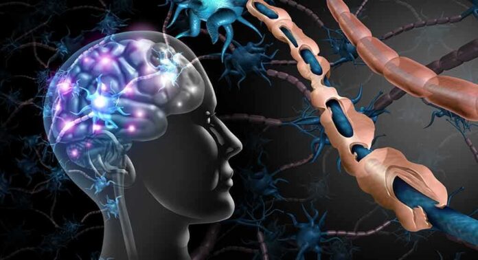 shutterstock_1436984567 Human brain and damaged myelin sheath illustration