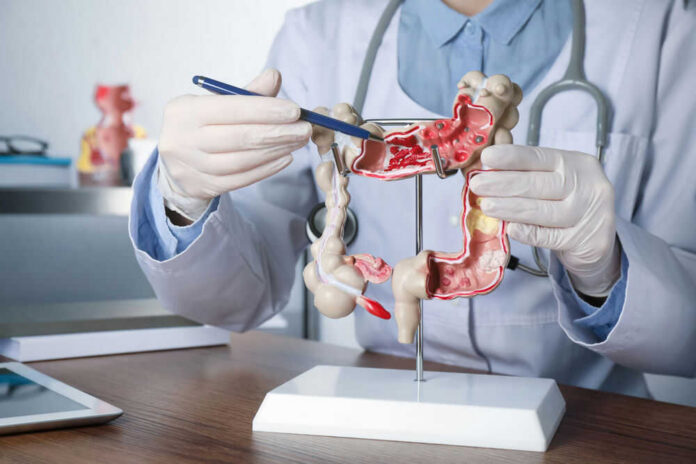 1999071686 Doctor pointing at anatomical model of the colon.