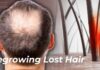 How to Stop Hair Loss: Science of Minoxidil & Finasteride