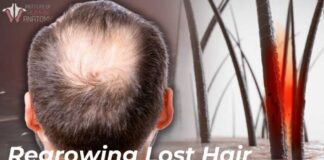 How to Stop Hair Loss: Science of Minoxidil & Finasteride