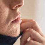 Close-up of lower face with acne scars and hand pulling up fabric