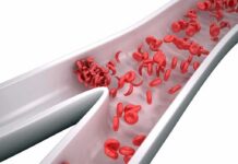 Hidden Time Bombs In American Arteries Red blood cells in a narrowed blood vessel
