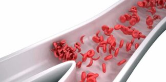 Red blood cells in a narrowed blood vessel