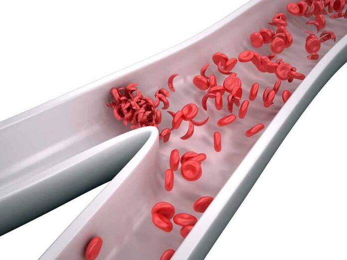 shutterstock_211264888 Red blood cells in a narrowed blood vessel