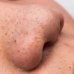 close-up of a nose with visible blackheads