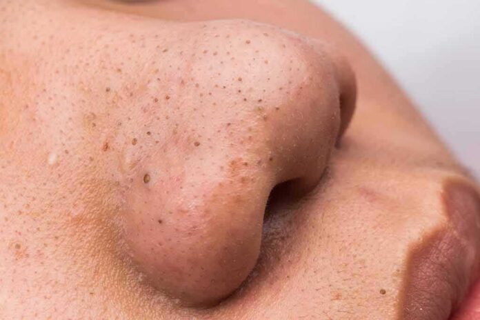 shutterstock_241995088 close-up of a nose with visible blackheads
