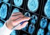 COVID’s Brain Damage Finding Hand with pen pointing at brain MRI scans